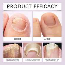 Load image into Gallery viewer, Fungi Free Bee Venom Nail Serum( Buy 1 Get 1 FREE! )⏰ Don't Miss Out!😍