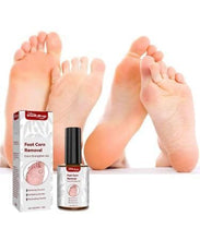 Load image into Gallery viewer, Feet Corn Removal Serum (Buy 1 Get 1 FREE) 🦶➡️😊