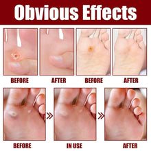 Load image into Gallery viewer, Feet Corn Removal Serum (Buy 1 Get 1 FREE) 🦶➡️😊
