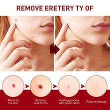Load image into Gallery viewer, Buy 1   Get 1 FREE 🎁✨Tags &amp; Moles Remover,! ✨
